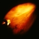 peripheral pre-retinal fibrosis and neovascularization with vitreous cutter